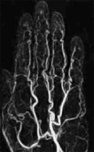 angiogram of hand showing blood vessels
