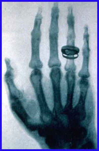 x ray showing skelton of hand with a ring on finger